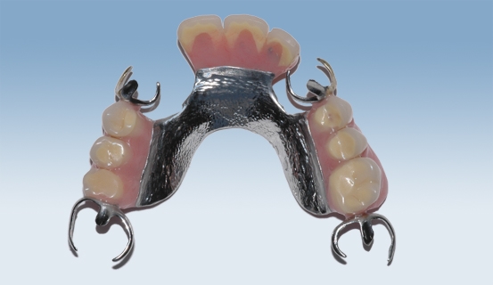 a vitallium 1