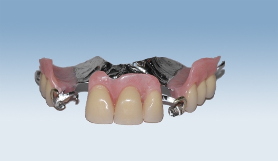 a vitallium 2