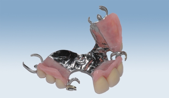 a vitallium 3
