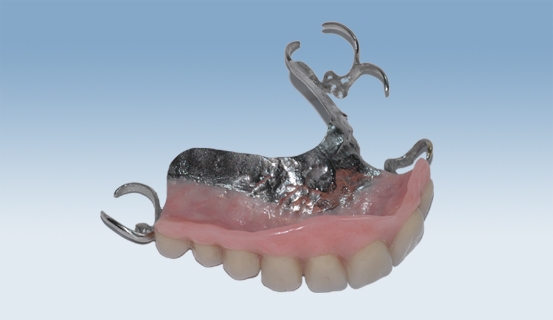 a vitallium 6