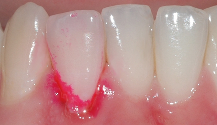 gingivitt Pasient 1 3