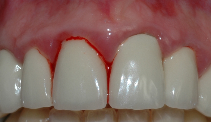 gingivitt pasient 2 2