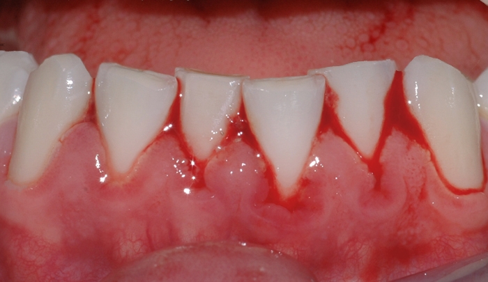 gingivitt pasient 3 2