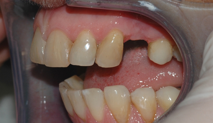 implantat klinisk 1