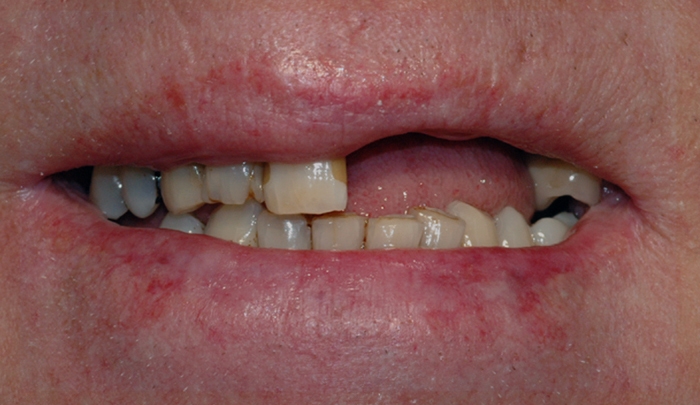implantat klinisk 4